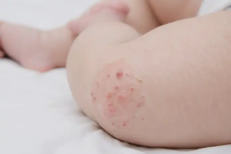 嬰兒大腿經(jīng)常起濕疹能靠自己自愈嗎(圖4)