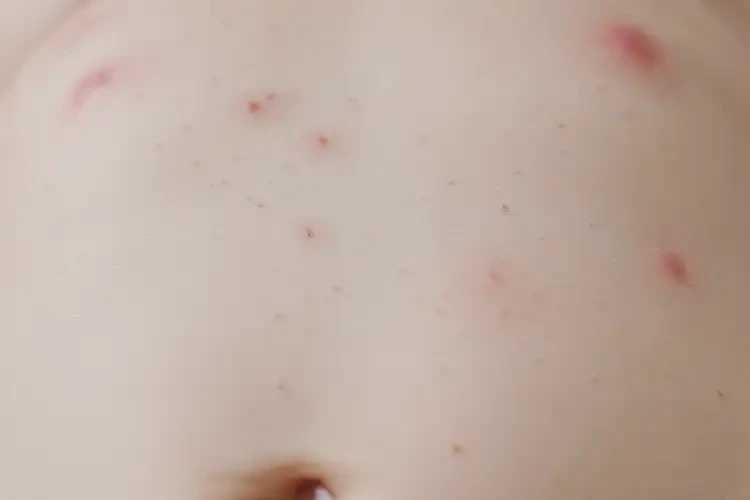 嬰兒肚子上出濕疹可不可以自愈(圖4)