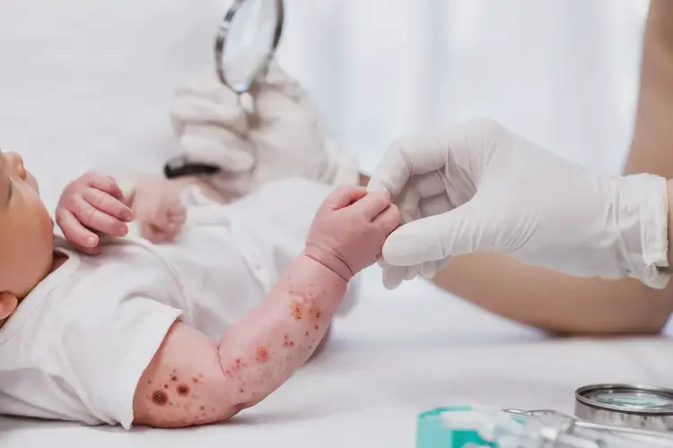 新生兒手臂出濕疹康復(fù)的全過程(圖3)