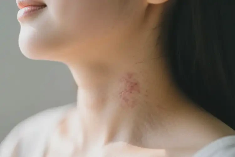 产妇脖子上出现湿疹可以彻底自愈吗(图4)