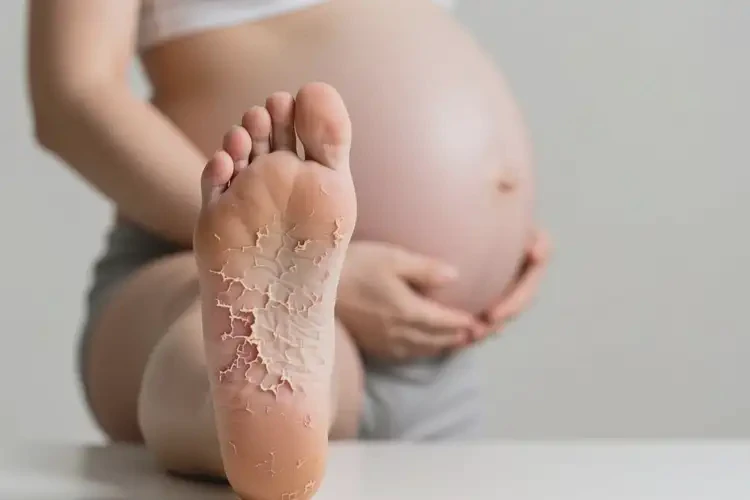 產(chǎn)婦腳上出濕疹能靠自己自愈嗎(圖1)