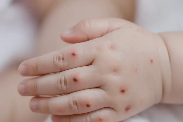 嬰兒手上偶爾長濕疹不管它會自己好嗎(圖3)