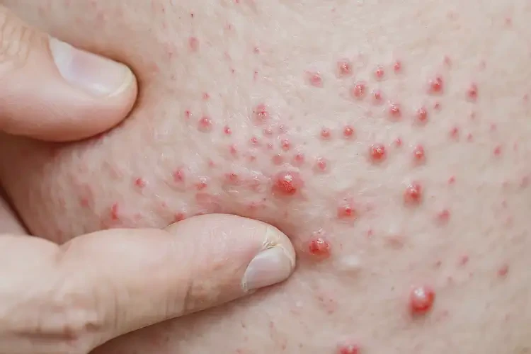 女人肚子上出湿疹不管它会自己自愈吗(图4)