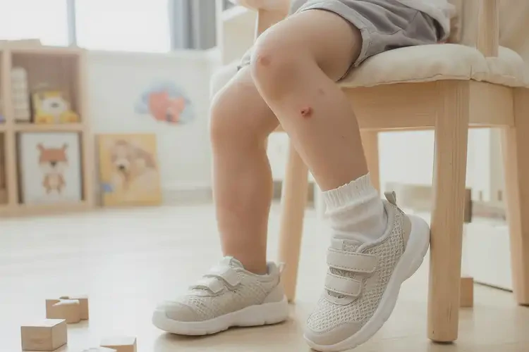 小孩腳上出濕疹可以徹底自愈嗎(圖2)