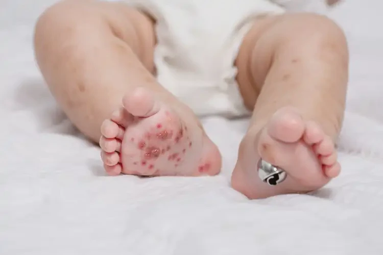 嬰兒小腿上經(jīng)常起濕疹能夠徹底治愈嗎(圖4)