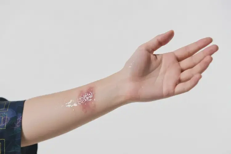 大學(xué)生手臂出濕疹可以徹底自愈嗎(圖3)