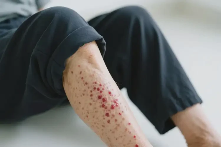 老年人大腿上容易起濕疹不管它會(huì)自己好嗎(圖3)