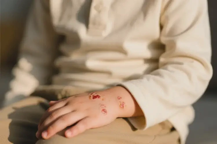 小孩手上容易起湿疹能够彻底治愈吗(图1)