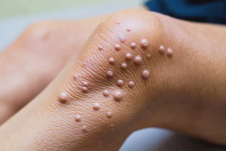 老人四肢起濕疹不管它會(huì)自己痊愈嗎(圖3)