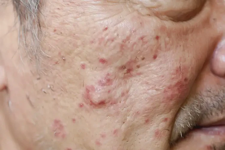 男人屁股起濕疹不管它會(huì)自己好嗎(圖4)