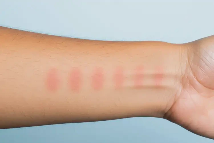 男性手臂上偶爾長(zhǎng)濕疹可以徹底自愈嗎(圖1)