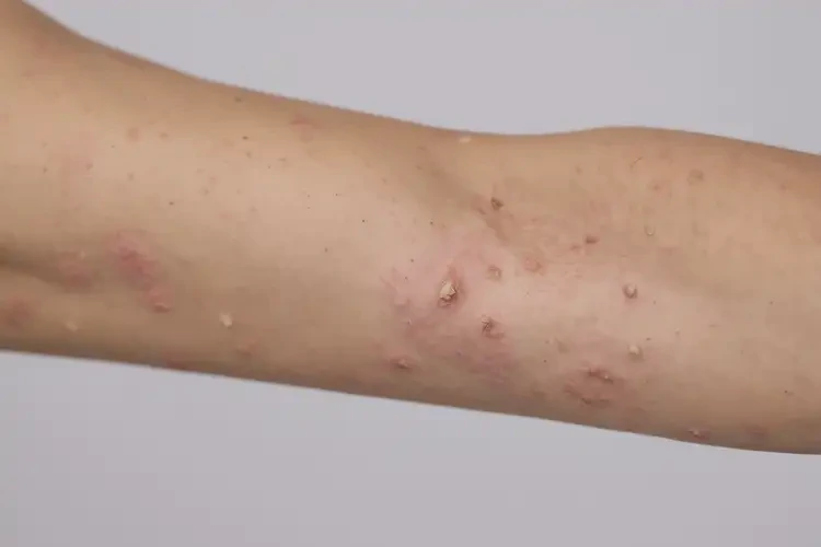 女生手臂上出現(xiàn)濕疹可以徹底自愈嗎(圖4)
