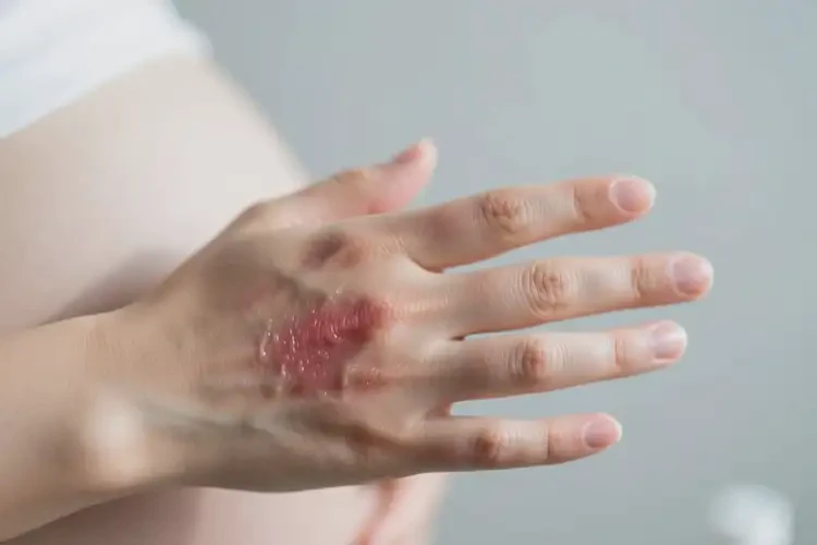 孕婦手上出現(xiàn)濕疹可不可以自愈(圖1)