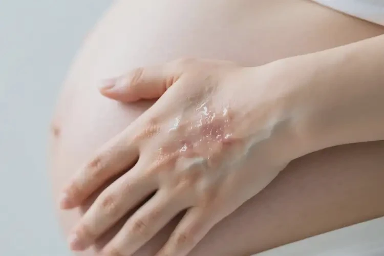 孕婦手上出現(xiàn)濕疹可不可以自愈(圖2)