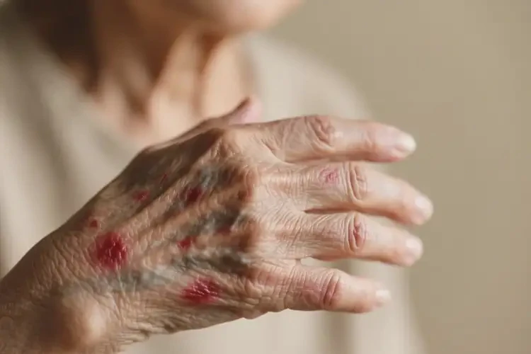 老年人身上偶尔长湿疹可不可以自愈(图4)