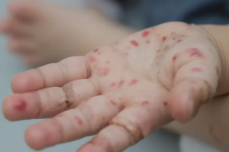 小孩手上起濕疹能不能徹底自愈(圖3)