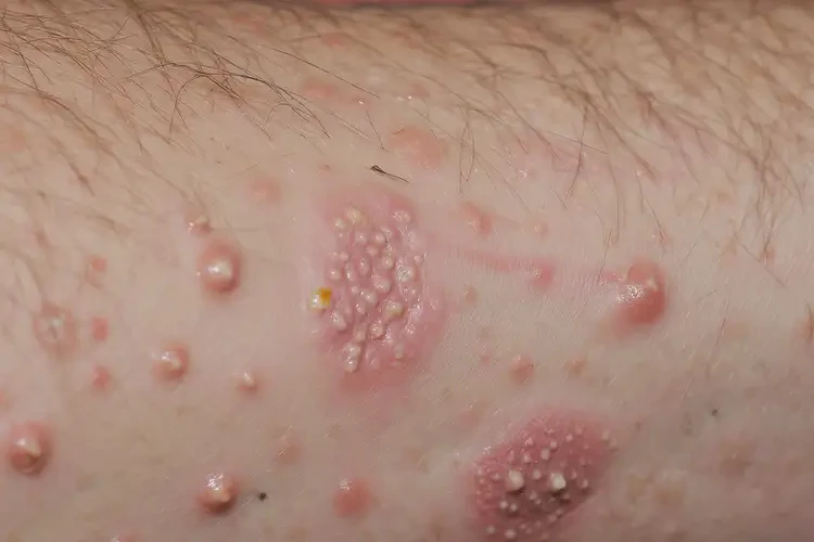 哺乳期媽媽全身偶爾起濕疹能徹底自愈嗎(圖2)