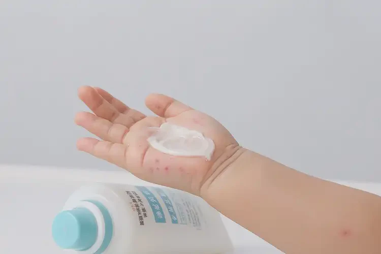 兒童手上有濕疹可不可以徹底自愈(圖3)