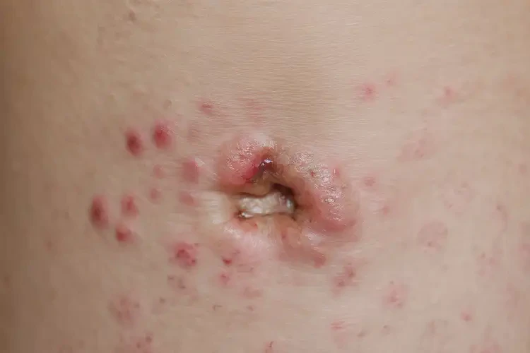 青少年肛周經(jīng)常起濕疹可以徹底自愈嗎(圖4)