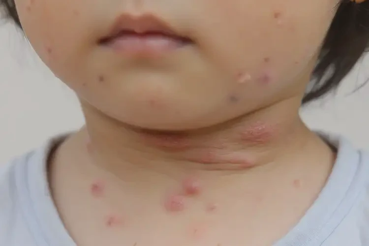 小孩脖子經(jīng)常長濕疹可以徹底自愈嗎(圖4)