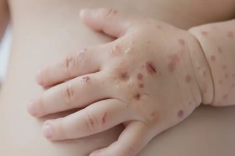 幼儿手上出湿疹能彻底自愈吗(图4)