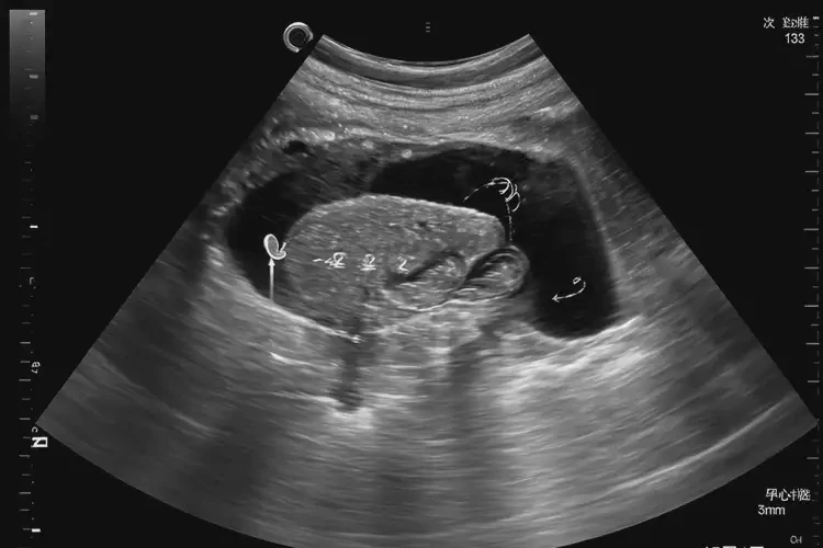 孕5周4天胎心133正常吗(图4)
