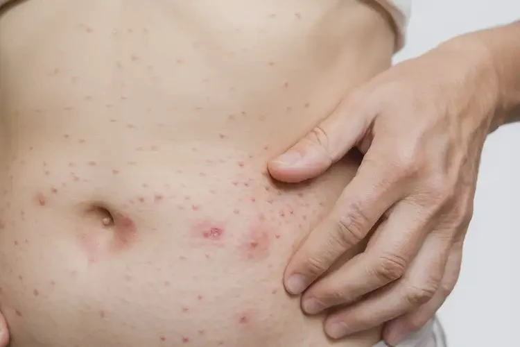 女人肚子上偶爾長濕疹不管它會自己自愈嗎(圖4)