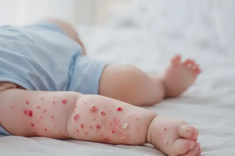 寶寶全身長濕疹不管它會自己痊愈嗎(圖4)