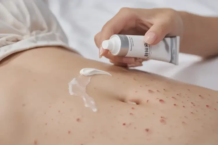 青少年肚子有濕疹可不可以徹底自愈(圖3)