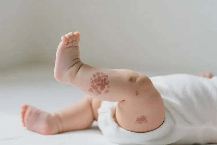 嬰幼兒小腿上有濕疹不管它會自己好嗎(圖2)