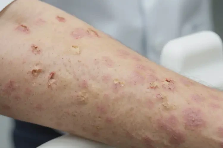 中學(xué)生脖子起濕疹能不能徹底自愈(圖3)