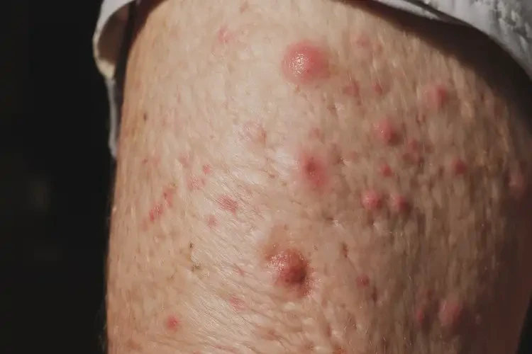 老人大腿上出濕疹不管它會自己痊愈嗎(圖4)