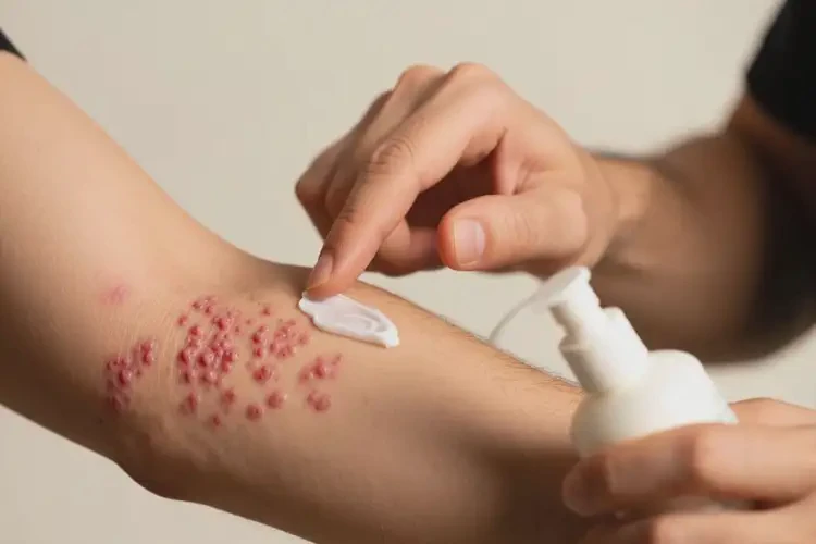 男人出現(xiàn)濕疹怎么處理(圖3)