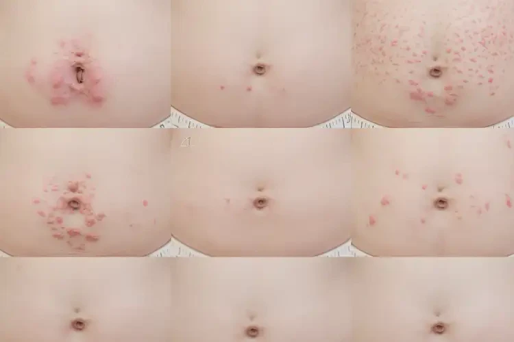 嬰兒肚子上出濕疹可不可以自愈(圖3)