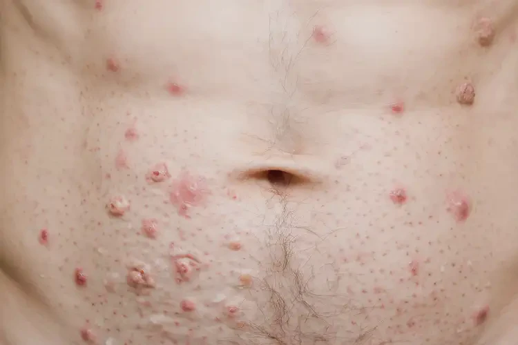 女人肚子上偶爾長濕疹不管它會自己自愈嗎(圖3)