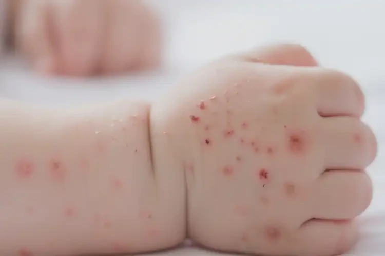 嬰兒手臂上出現(xiàn)濕疹可以徹底自愈嗎(圖4)