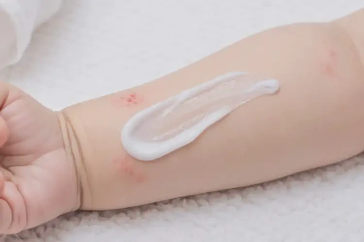 寶寶手臂上有濕疹能夠治愈嗎(圖3)