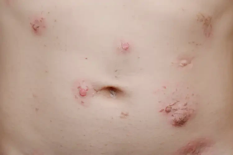 兒童肚子出現(xiàn)濕疹不管它會自己自愈嗎(圖4)