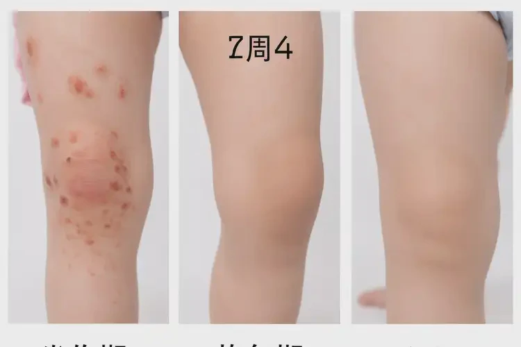 幼儿大腿上长湿疹可不可以彻底自愈(图3)