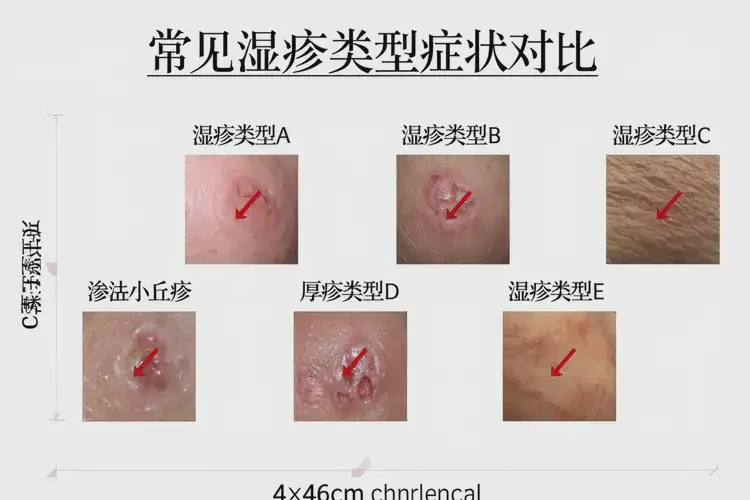 小孩脖子上起濕疹可不可以徹底自愈(圖1)