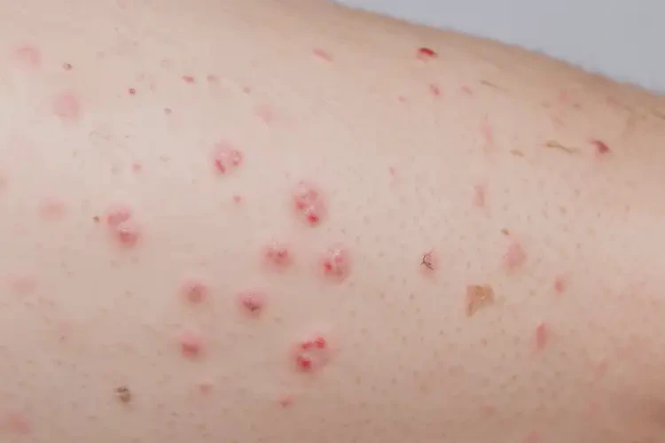 孩子四肢出現(xiàn)濕疹不管它會(huì)自己自愈嗎(圖4)