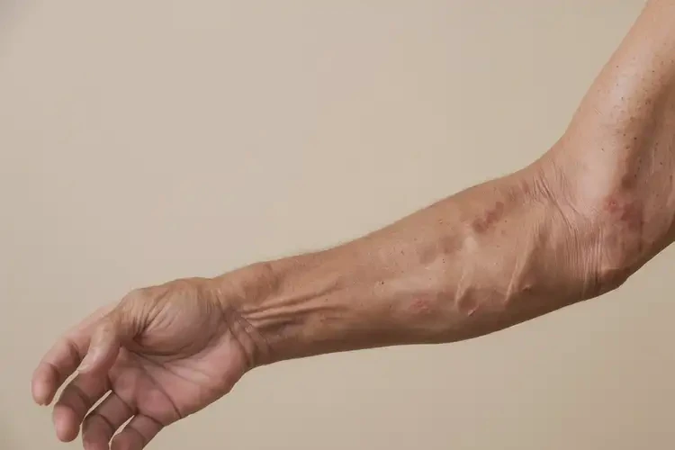 老年人手臂上有濕疹怎么算是痊愈(圖2)