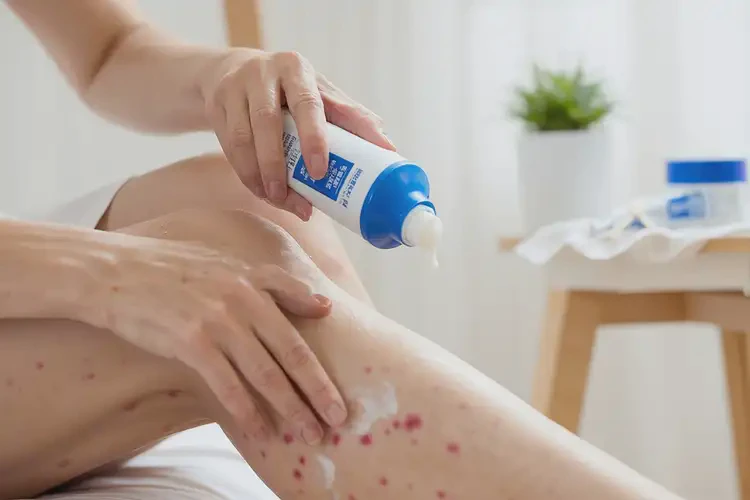 女生大腿長(zhǎng)濕疹可不可以徹底自愈(圖3)