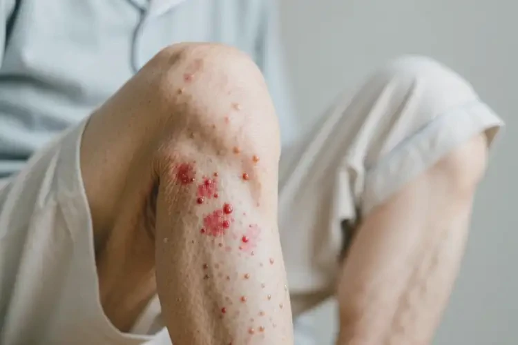 老年人大腿上容易起濕疹不管它會(huì)自己好嗎(圖2)