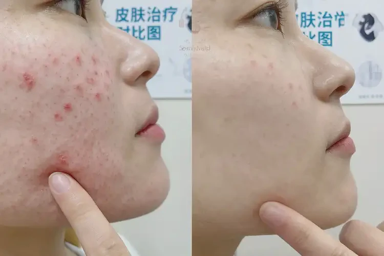 青少年肛周經(jīng)常起濕疹可以徹底自愈嗎(圖1)