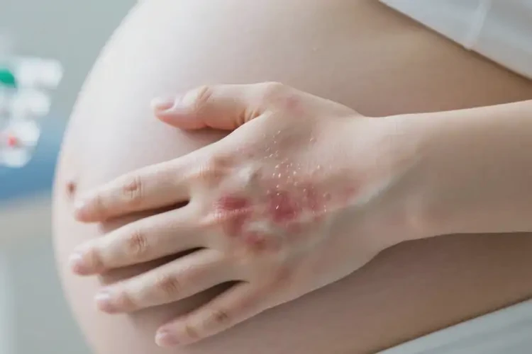 孕婦手上出現(xiàn)濕疹可不可以自愈(圖4)