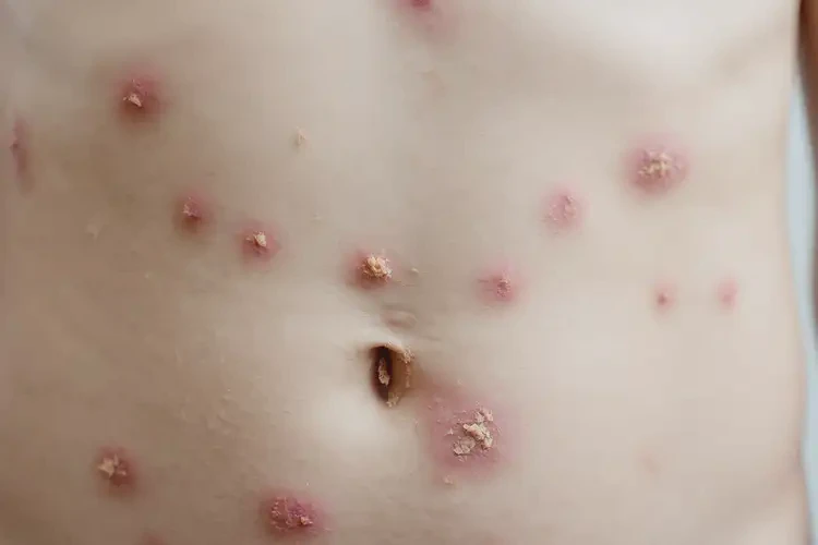 小學(xué)生肚子上經(jīng)常起濕疹不管它會(huì)自己痊愈嗎(圖4)