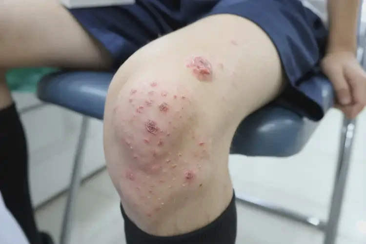 中學(xué)生腳上容易起濕疹不管它會(huì)自己自愈嗎(圖4)