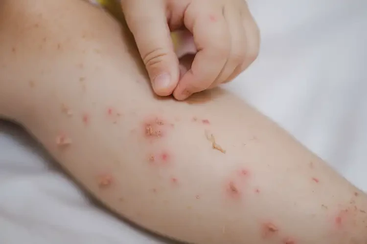 小孩小腿上偶爾起濕疹能靠自己自愈嗎(圖4)