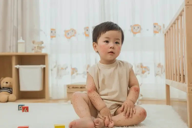 幼兒面部出現(xiàn)濕疹不管它會自己自愈嗎(圖1)